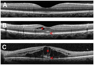 Mechanisms of macular edema